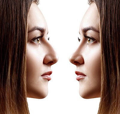 Rhinoplasty Surgery San Ramon, CA